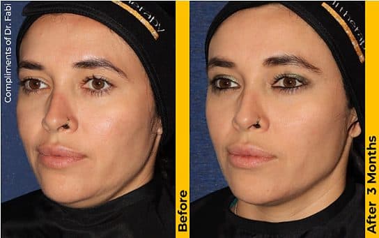 Before and after Ultherapy, three-quarter view showing a lifted brow and firmer under-chin at 3 months