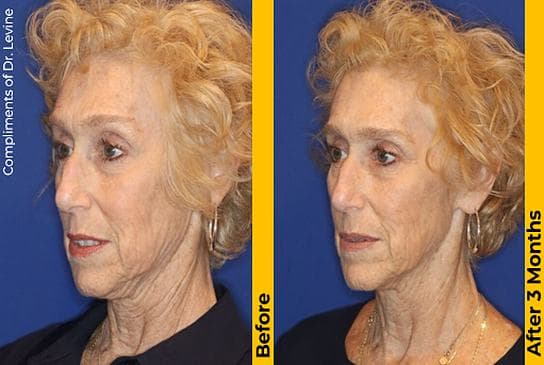 Before and after Ultherapy, side profile showing a lifted jawline and neck at 3 months