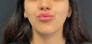 Lip filler — after