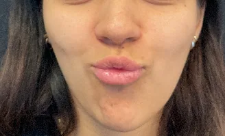 Lip filler — before