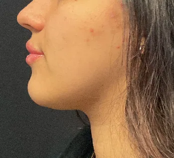 Lip filler — after