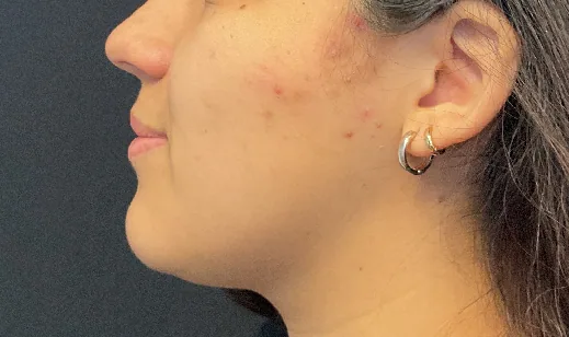 Lip filler — before