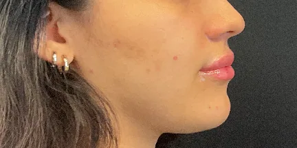 Lip filler — after