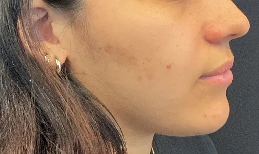 Lip filler — before
