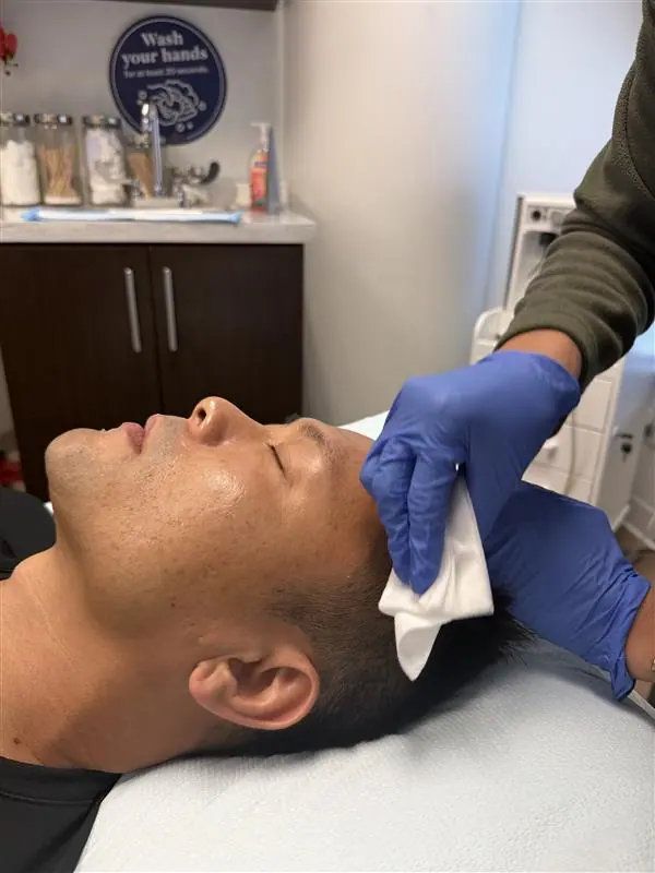 RF microneedling treatment