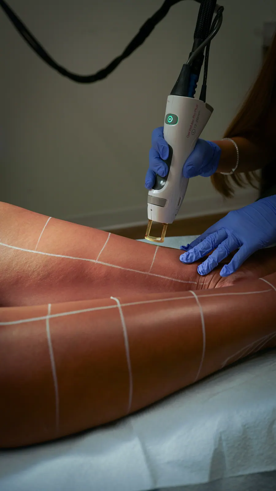 Laser hair removal on the forearm with treatment grid mapped in white