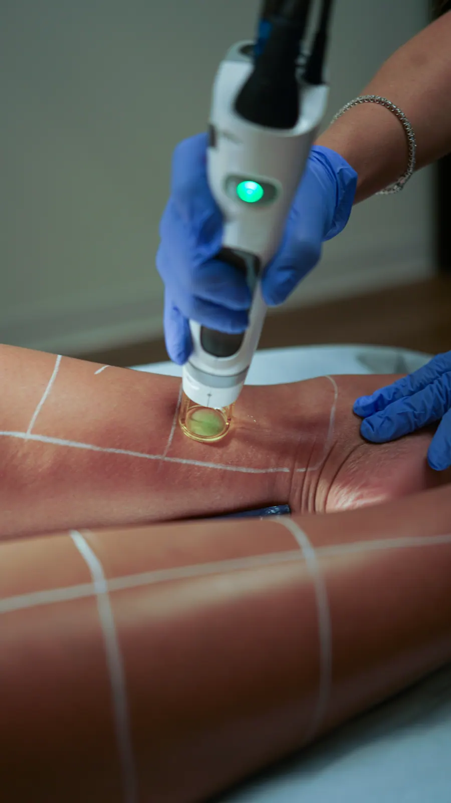Clinician guiding the laser handpiece along a mapped forearm
