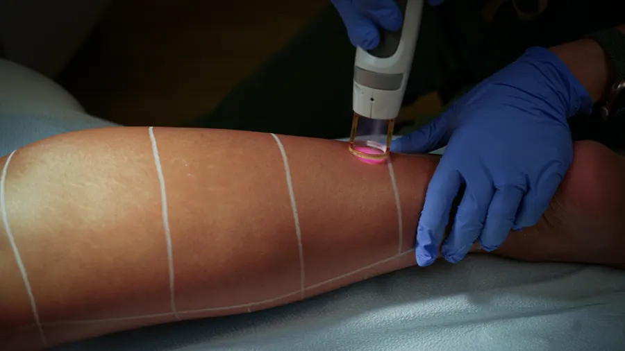 Laser hair removal on the leg with treatment grid